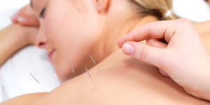 Acupuncture services by best acupuncture clinic New Caledon Physiotherapy Centre in Brampton, Caledon, Vaughan